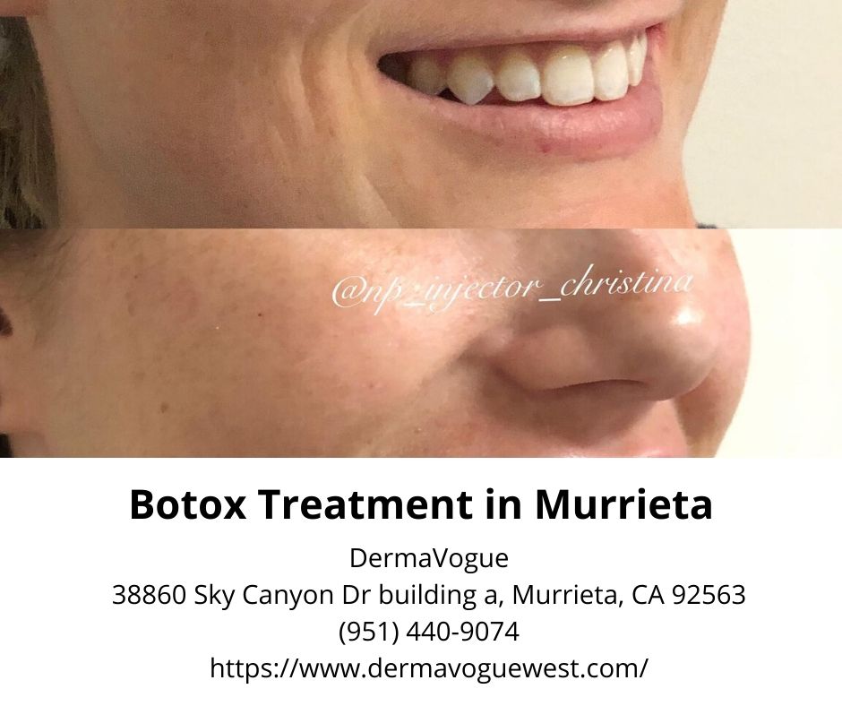 botox treatment in murrieta